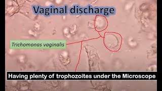 Trichomonas pus cells epithelial cells RBCs in vaginal swab microscopy [upl. by Schechinger]