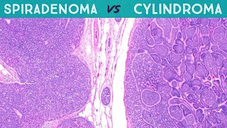 Spiradenoma vs Cylindroma Dermpath in 5 Minutes pathology dermatology dermatopathology sweat gland [upl. by Learsi]