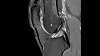 Fatty impingement in anterior knee [upl. by Mallen]