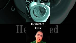 Herniated Disc  usmle Review [upl. by Corrina]