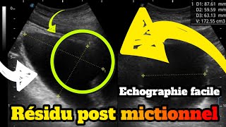 Evaluation du résidu post mictionnel en échographie [upl. by Eelyme]