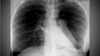 Chest xray Pneumomediastinum [upl. by Elleval157]