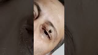 Botfly Maggot Removal spa doctor satisfying pimple removal [upl. by Neale]