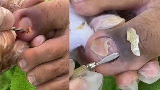 Top ASMR Expert Shares Ear Wax Removal Secrets យូយៗបងអើយកប់ ហើមស្ពីង😂😂 nail​​​ asmr fyp ear [upl. by Schapira744]