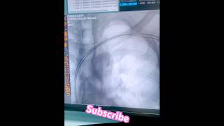 Pacemaker procedure pacing LBBB Double chambers ❤️🫀🫀❤️❤️🫀 [upl. by Nyliram]