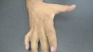 Ulnar nerve palsy [upl. by Auqenet679]