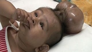 Baby Born With Two Heads  Extraordinary Birth [upl. by Gross]