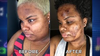 DIY Chemical Peel Dangers [upl. by Ohploda]