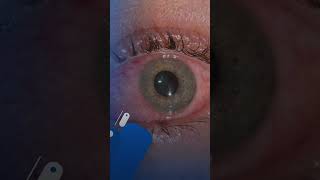 Marburg virus  potential eye issues [upl. by Eiger]