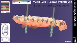 Medit i500  Exocad Valletta 22  Screw retained crowns design [upl. by Prent]