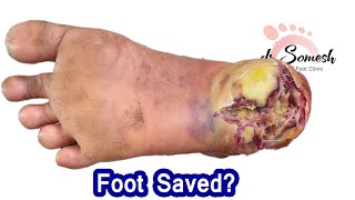 heel infection Diabetic Gangrene Healing by podiatist chennai [upl. by Gorman870]