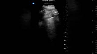 Right Pleural Effusion with Compression Atelectasis [upl. by Euqinay]