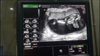 Fetal Early Anomaly scan can be much earlier than what we see in this fetusDr Kishan Bhagwat [upl. by Atinit]