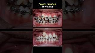 Braces for crowded teeth braces orthodontist dentistry dentist [upl. by Eisnil]