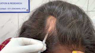 Alopecia areata  Injection technique for Triamcinolone acetonide  10 mgmL Dr Bhawuk Dhir [upl. by Christoforo]