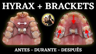 Proceso 𝗠𝗘𝗦 𝗮 𝗠𝗘𝗦  HYRAX  BRACKETS  Tratamiento ORTODONCIA [upl. by Aleek]