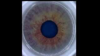 LASIK Eye Surgery with iFS Laser [upl. by Oj]