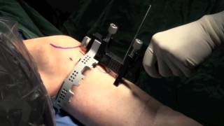 Surgery Video Subchondroplasty [upl. by Drolyag]