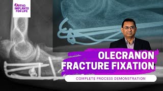 Olecranon Fracture Fixation  Procedure Demonstration [upl. by Byran]