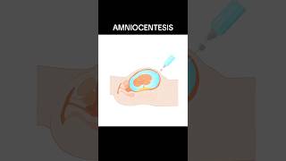 AMNIOCENTESIS amniocentesis  WHAT IS AMNIOCENTESIS shortsviraltrending [upl. by Atahs]