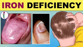 Iron Deficiency Anemia  Signs amp Symptoms  Iron Deficiency  Early amp Late Signs [upl. by Aramenta456]