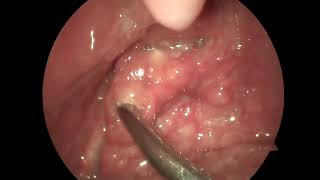 숨은 편도결석 제거 removal of tonsil stones [upl. by Halbeib]