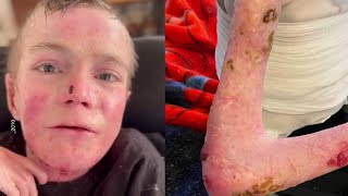 TikToker Dies of Rare Genetic Disease That Causes Skin to Blister [upl. by Shelden]