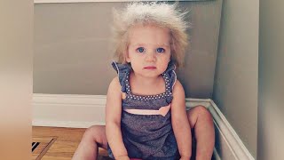 What Is Causing Child’s Uncombable Hair Syndrome [upl. by Jehias]