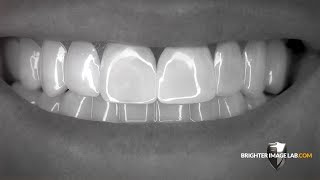 Brighter Image Lab BilVeneers™ The Future of No Dentist Dental Veneers [upl. by Issirk]