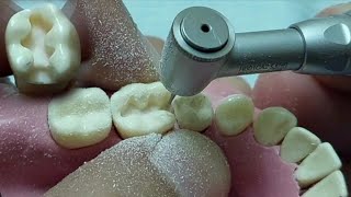 تريكات ال cavity preparation وازاى تجهز كلاس ٢ بكل سهولهClass II amalgam preparation [upl. by Morna]