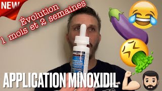 Comment appliquer le minoxidil Évolution 1 mois et 2 semaines [upl. by Azarria]