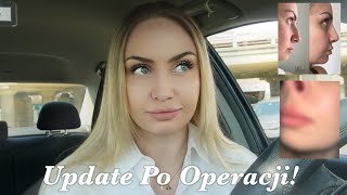 10 MIESIĘCY PO OPERACJI NOSA  update 🥰 [upl. by Fields]