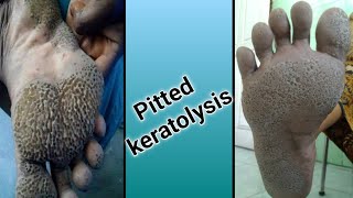 Pitted Keratolysis [upl. by Eikcaj]