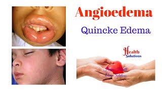 Angioedema  Quincke Edema [upl. by Perri]