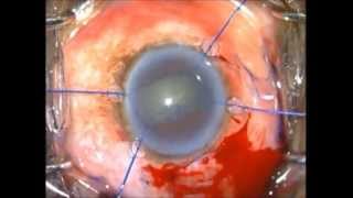 SMALL PUPIL SICS COMPLICATED CATARACT PUPILLARY MEMBRANE [upl. by Appilihp]