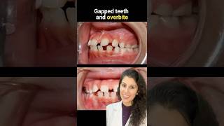 Teeth gap treatment with Braces shorts viralvideo dental trending braces invisalign aligners [upl. by Nesyaj678]