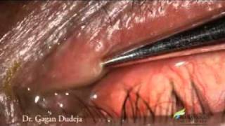 Mini Monoka Stent for Punctal Stenosis [upl. by Ricki806]