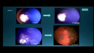 AIOC2018  FP850  Pediatric Ophthalmology  II  Topic  IntraArterial Chemotherapy [upl. by Carlye]