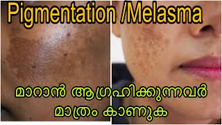 100 Result ഉറപ്പ് PigmentationMelasma മാറാൻ ഈതെറ്റുകൾ ചെയ്യല്ലേ How to treat melasma at home [upl. by Fineberg]