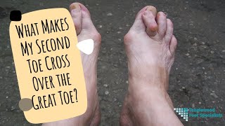 What Makes My Second Toe Cross Over the Great Toe [upl. by Spratt437]