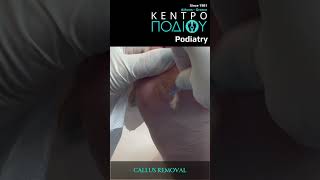 Callus RemovalΑφαίρεση Κάλου footpain κεντροποδιου foot callus podiatrist corn podiaty [upl. by Cherian]