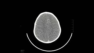 Anoxic brain injury with pseudosubarachnoid hemorrhage [upl. by Rubia]