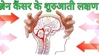 ब्रैन कैंसर के लक्षणbrain cancer ke lakshanbrain cancer symptoms hindi [upl. by Azzil27]