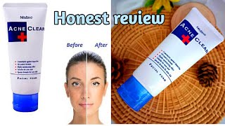 which is best face wash for acne  Mistine acne clear plus foaming face wash honest review [upl. by Simonsen]