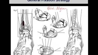 Tibial pilon fractures 2 [upl. by Ellimahs]