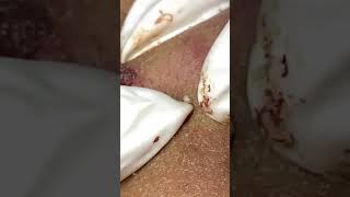 Big Cystic Acne Blackheads Extraction Blackheads amp Milia Whiteheads Removal Pimple Popping [upl. by Grand]