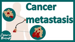 Cancer Metastasis  cancer metastasis mechanism  Metastasis  How do cancers spread in the body [upl. by Braynard21]