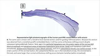 Corneal Ectasia Basics – A Deep Dive [upl. by Beata]