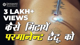 How To remove Tattoo Permanently  कैसे मिटायें परमानेंट टैटू को [upl. by Kipton943]