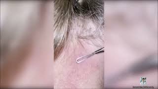 Ultimate Pimple Popping 2024 Intense Zit Solutions [upl. by Arika]